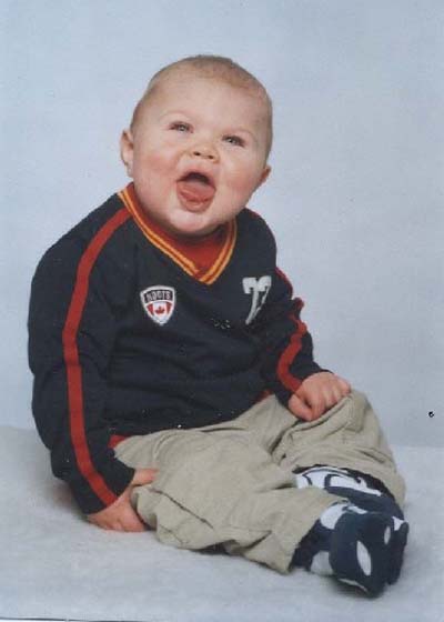 Beckwith-Wiedemann syndrome Beckwith-Wiedemann_syndrome (1).jpg
